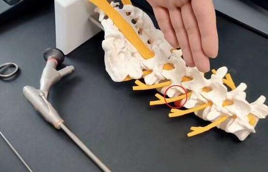 椎間(jiān)孔鏡創傷小(xiǎo)，身(shēn)邊患者早知(zhī)道(dào)！