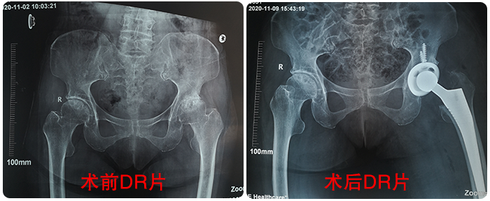博愛(ài)醫(yī)院成功收治百歲髋部骨折老(lǎo)人(rén)
