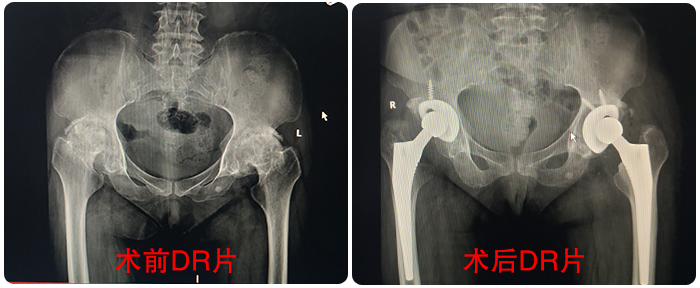 博愛(ài)醫(yī)院成功收治百歲髋部骨折老(lǎo)人(rén)