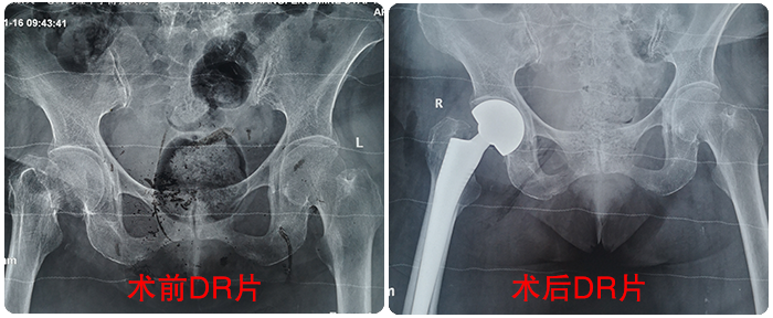博愛(ài)醫(yī)院成功收治百歲髋部骨折老(lǎo)人(rén)