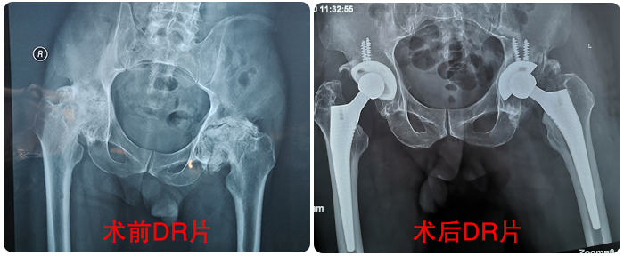 博愛(ài)醫(yī)院成功收治百歲髋部骨折老(lǎo)人(rén)