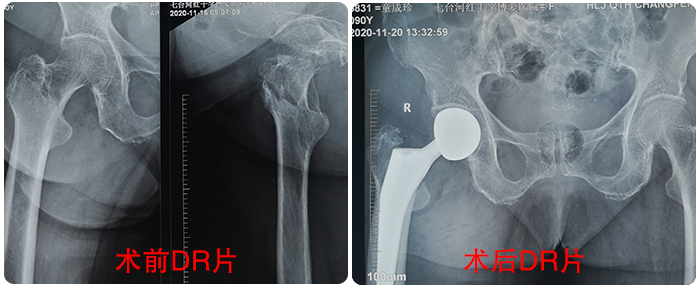 博愛(ài)醫(yī)院成功收治百歲髋部骨折老(lǎo)人(rén)